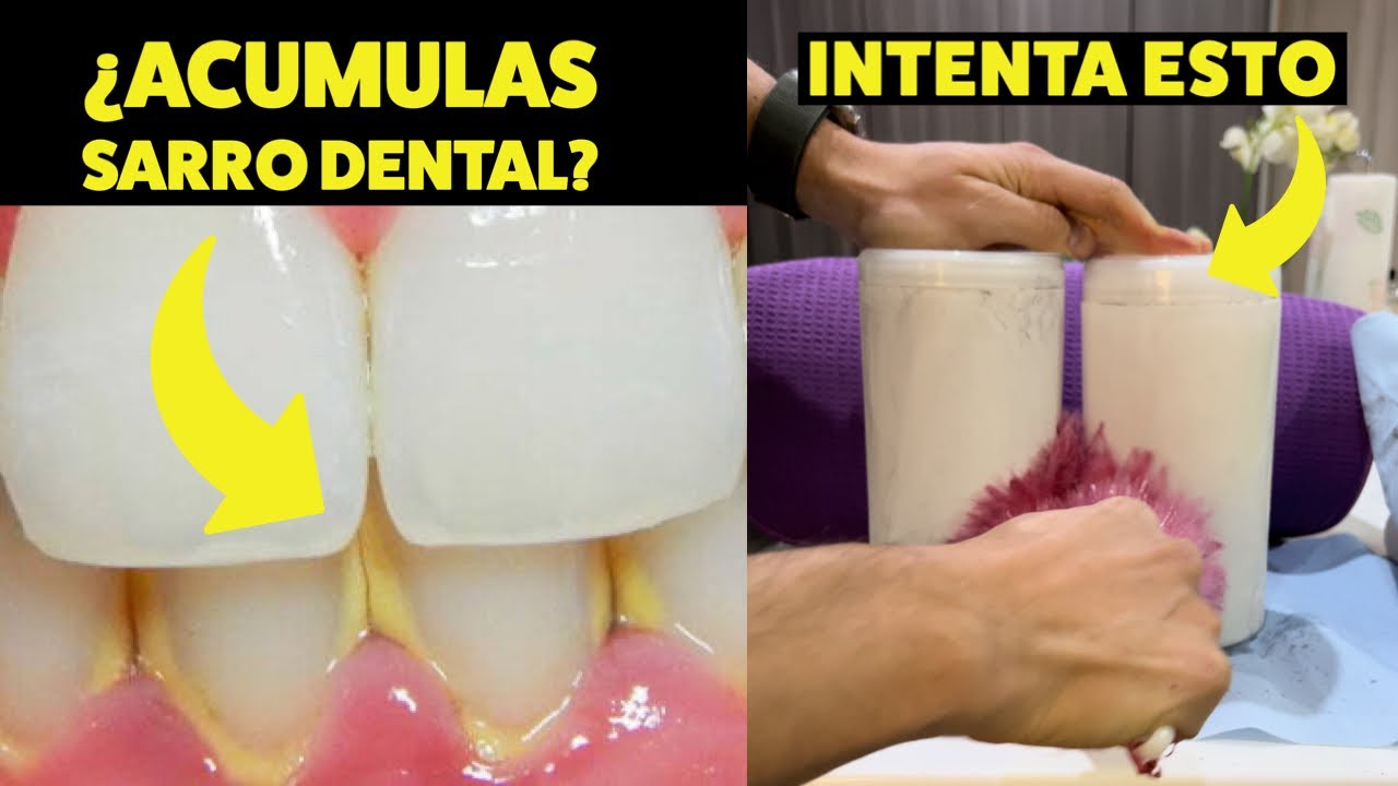 de que esta hecho el sarro delos dientes